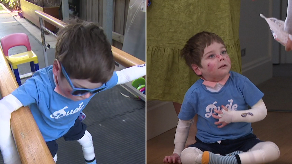 El 'Butterfly Boy' de Melbourne da el primer paso después