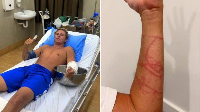 Horror de Irukandji: un surfista australiano hospitalizado tras sufrir una