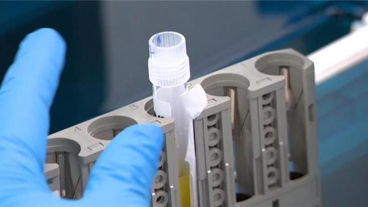 Un importante ensayo pretende detectar antes el Alzheimer mediante pruebas