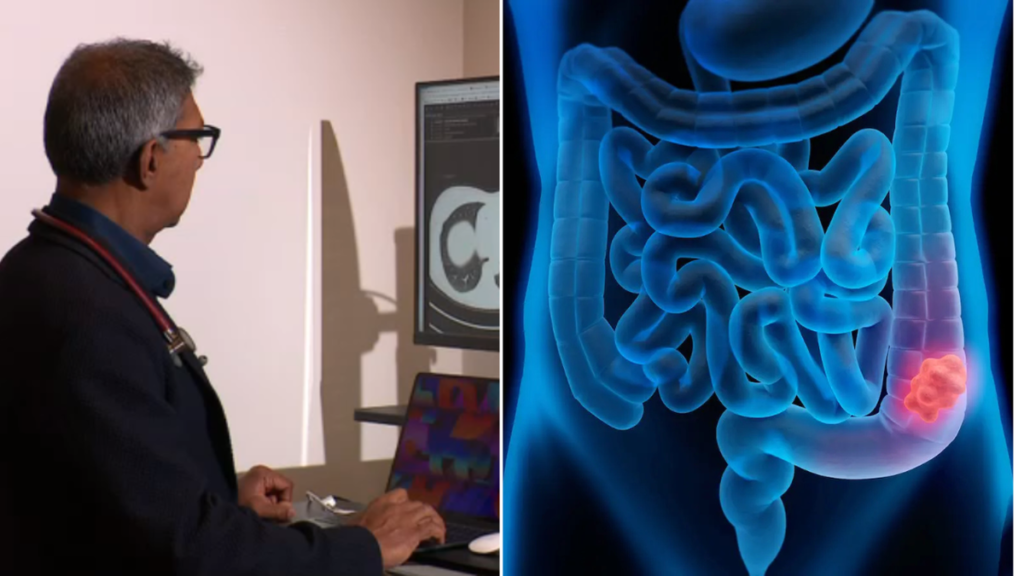 El cáncer de intestino de aparición temprana se considera una