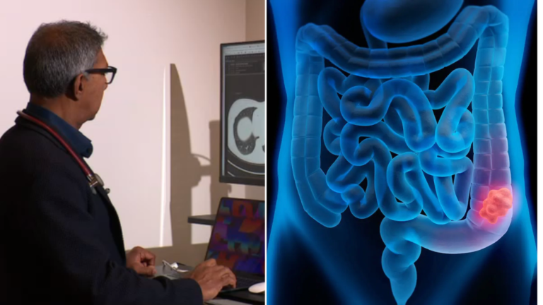 El cáncer de intestino de aparición temprana se considera una