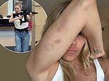 Sienna Miller montre ses bleus et ses accidents avec une