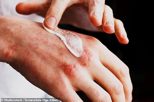 Une crème contre l'eczéma vendue sur Amazon a été rappelée
