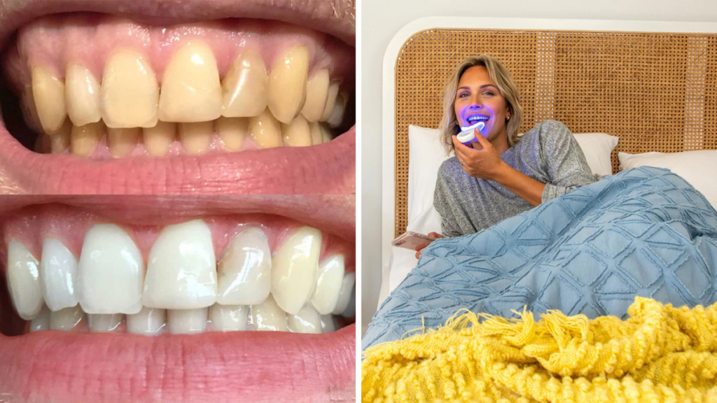 El kit de blanqueamiento dental galardonado cae hasta un 60
