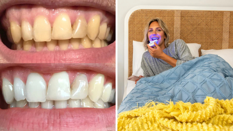 El kit de blanqueamiento dental galardonado cae hasta un 60