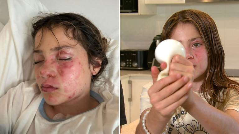 Una niña de Gold Coast sufrió graves lesiones faciales después