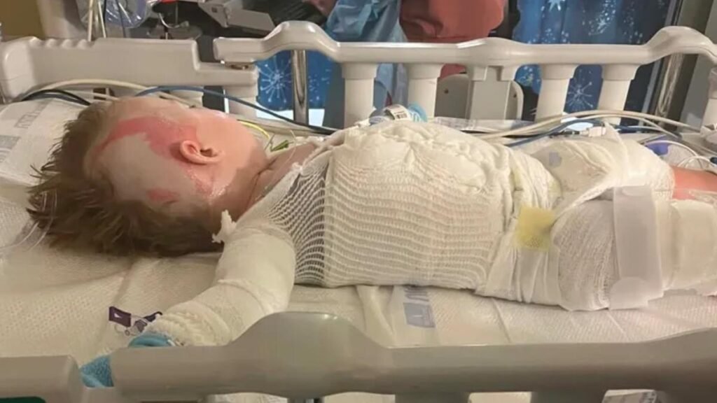 Kentucky, EE.UU.: El niño Dalynn Davis sufrió quemaduras de tercer