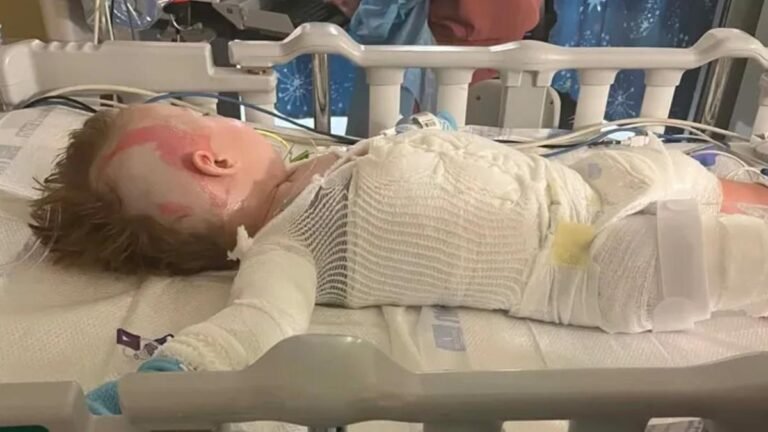 Kentucky, EE.UU.: El niño Dalynn Davis sufrió quemaduras de tercer